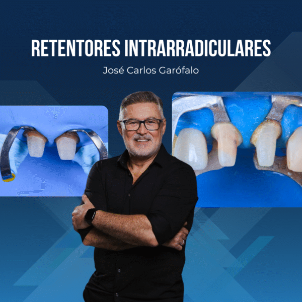 Retentores Intrarradiculares