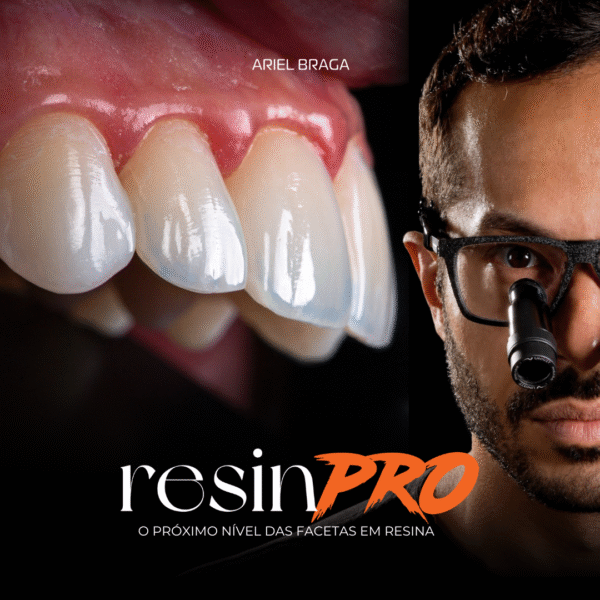 ResinPRO: O Próximo Nível das Facetas em Resina