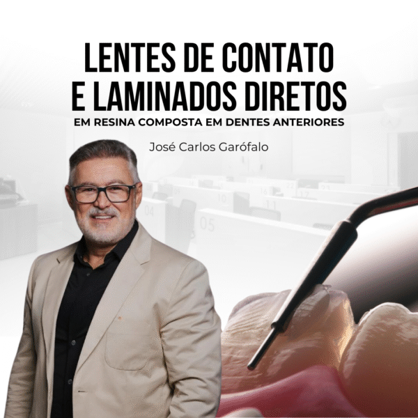 Lentes de Contato e Laminados Diretos em Resina Composta em Dentes Anteriores